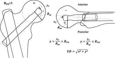 Eccentric distance zone analysis system: New regional evaluation of cephalic fixator tip location for predicting cut-out in geriatric intertrochanteric fractures with internal fixation